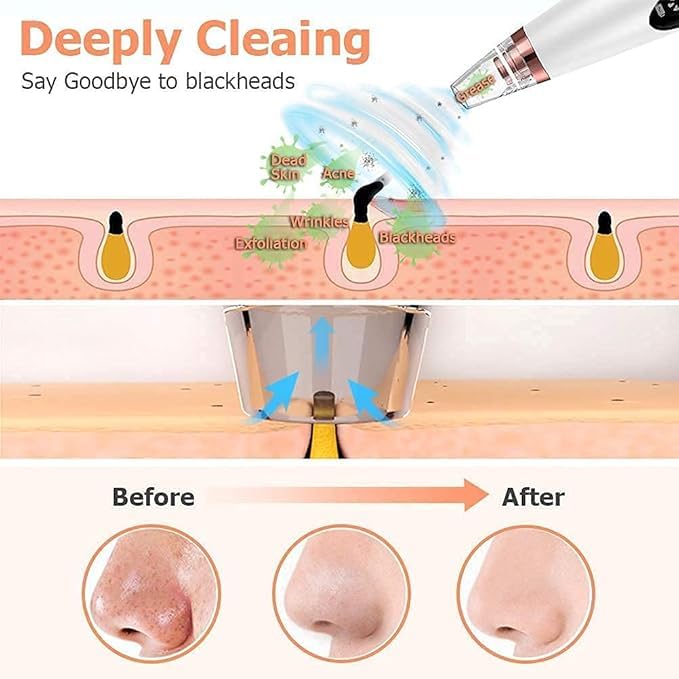 Goodingztore Blackhead Remover – Pore Vacuum Cleaner for Face